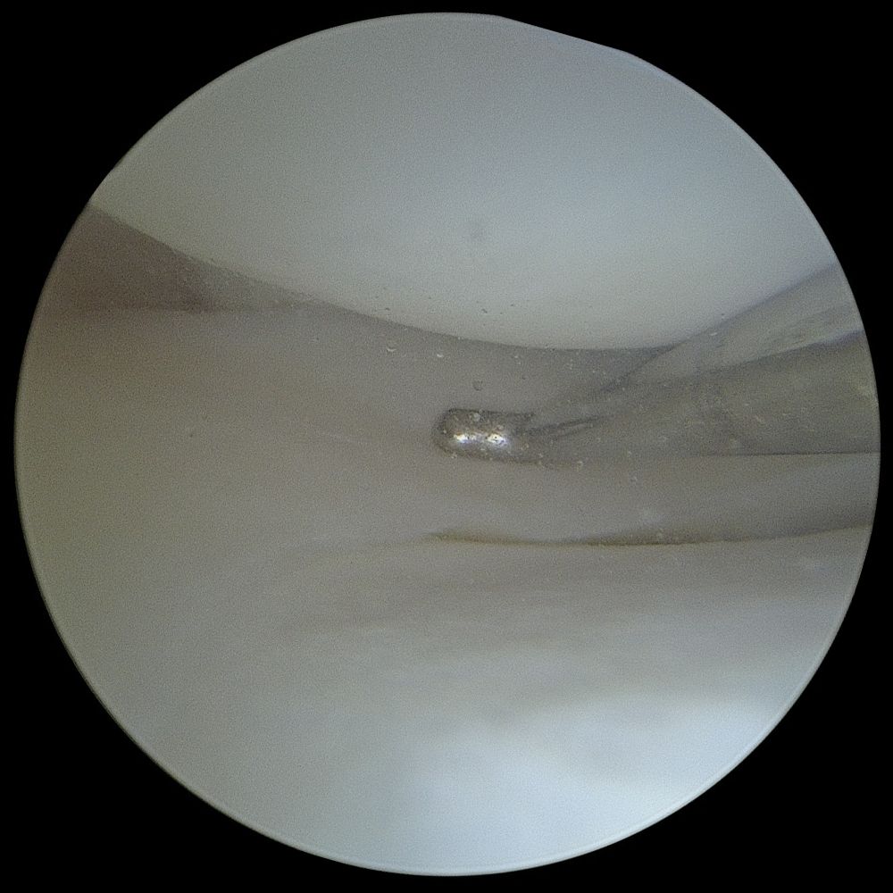 Minced cartilage autograft: arthroscopic camera view inside the knee showing smooth joint cartilage surfaces
