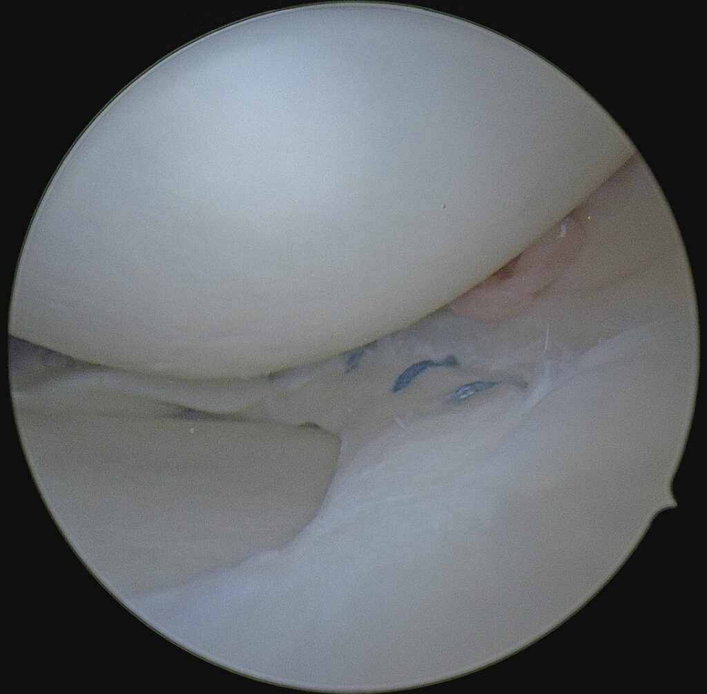 Repaired meniscus tear after meniscus repair surgery