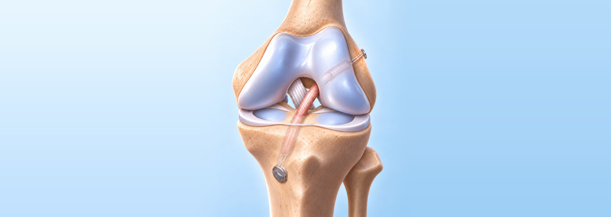 One-stage revision ACL reconstruction: illustration of the knee with a new ACL graft passing through tunnels in the thigh bone and shin bone