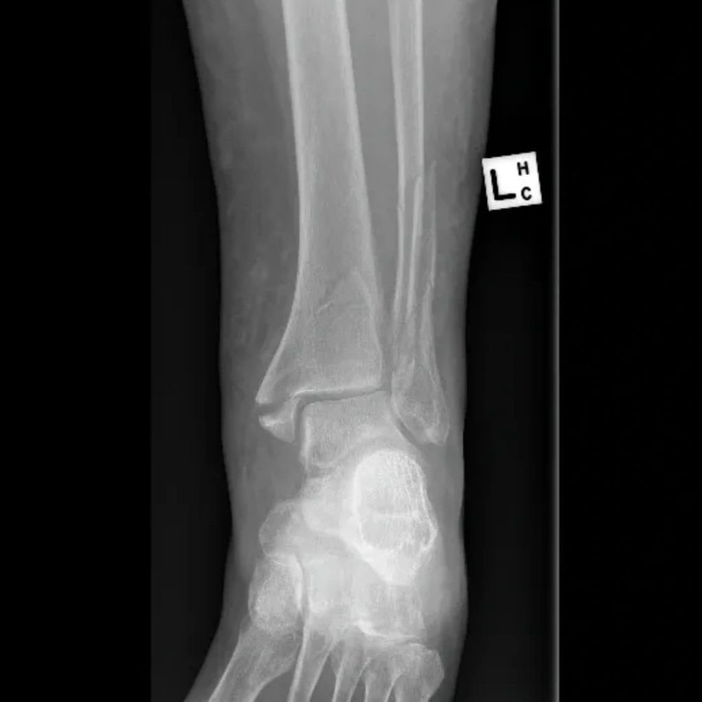 X-ray of an ankle fracture involving more than one part of the ankle