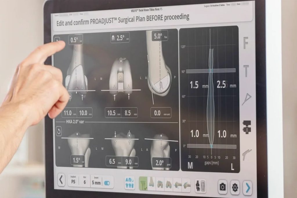 Robotic knee replacement planning screen showing implant position and alignment