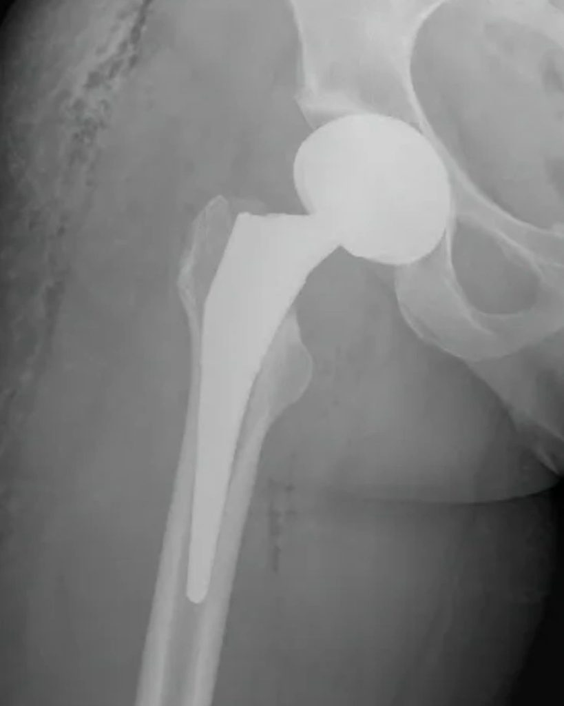X-ray of a total hip replacement