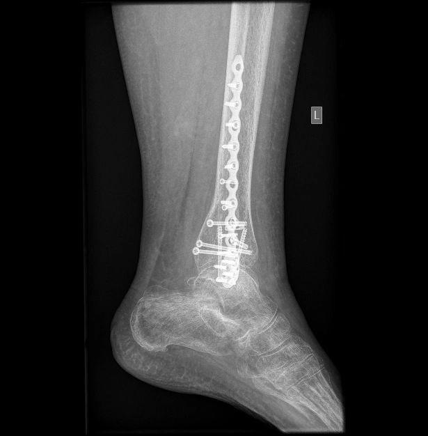 X-ray of the lower leg and ankle after fracture surgery