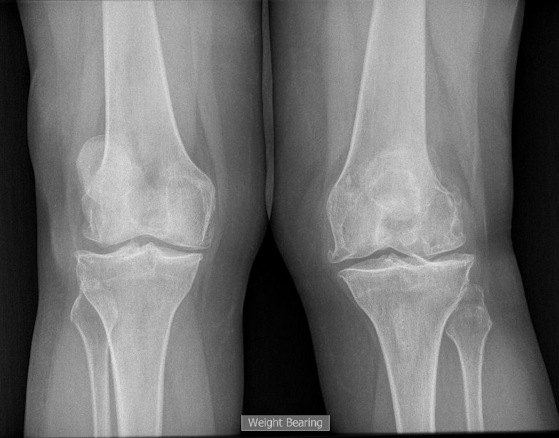 X-ray of both knees showing knee arthritis