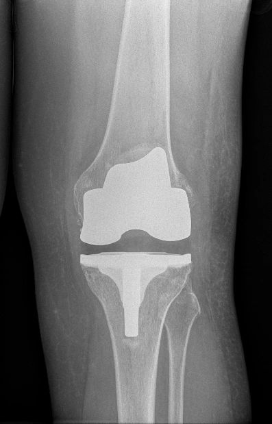 X-ray of a total knee replacement, front view