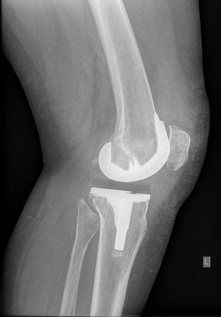 Total knee replacement lateral view