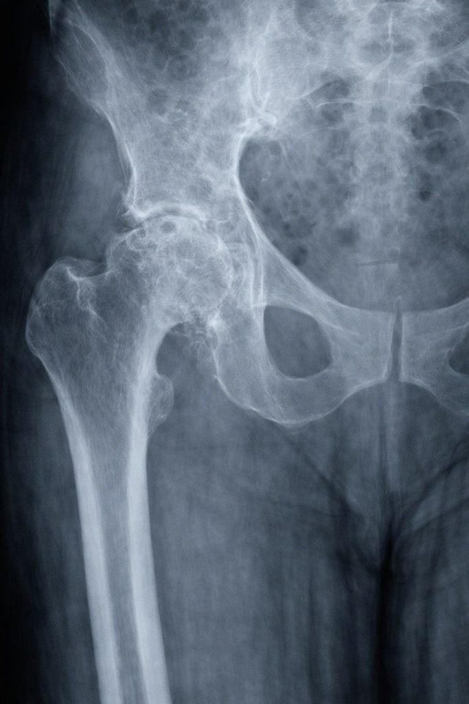 X-ray of the pelvis showing hip arthritis