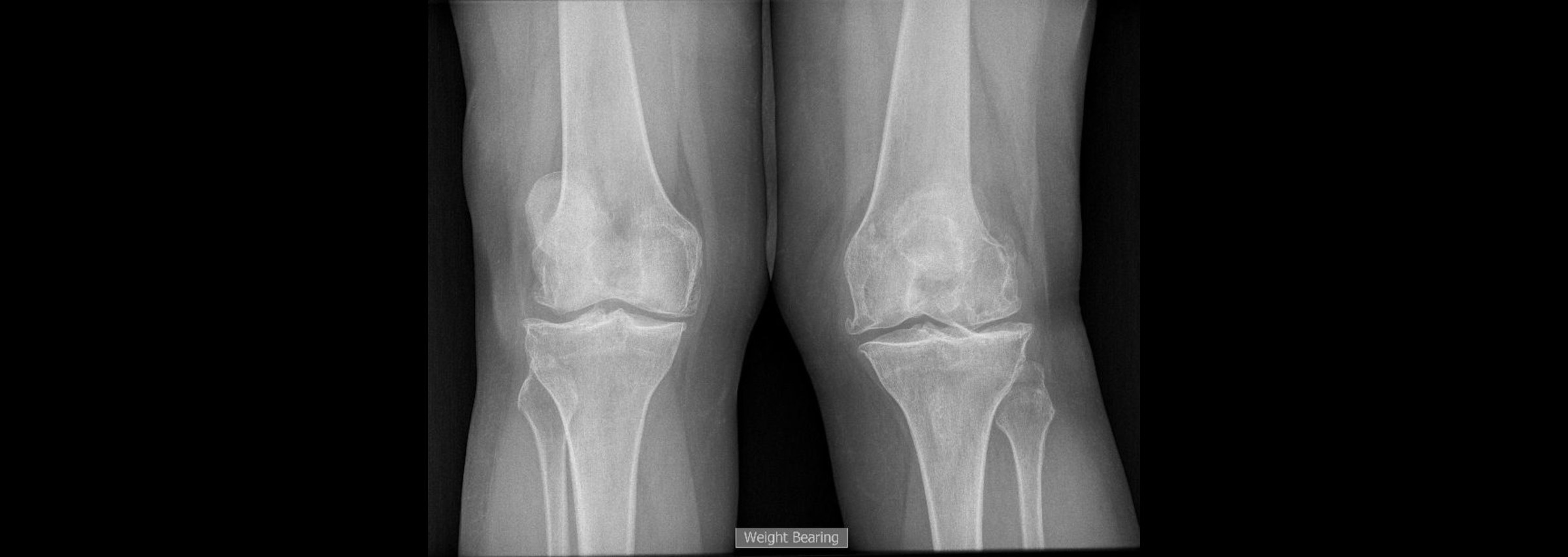 High tibial osteotomy: standing X-ray of both knees showing arthritis, the type of weight-bearing imaging used to assess knee alignment