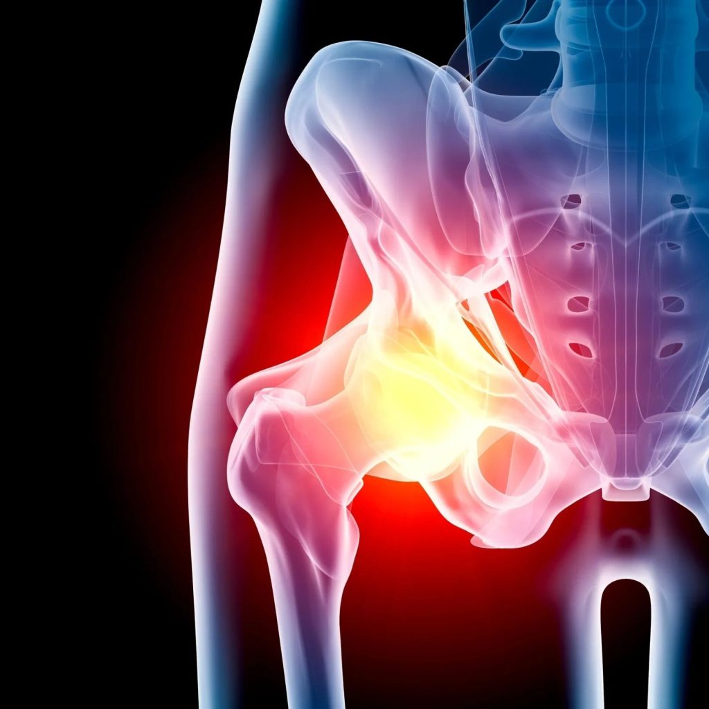 Illustration of the hip joint highlighting a neck of femur fracture