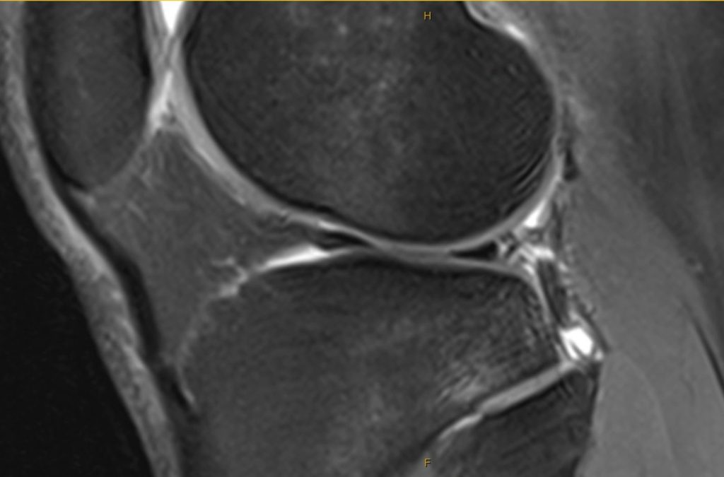 MRI scan of the knee showing a meniscus tear