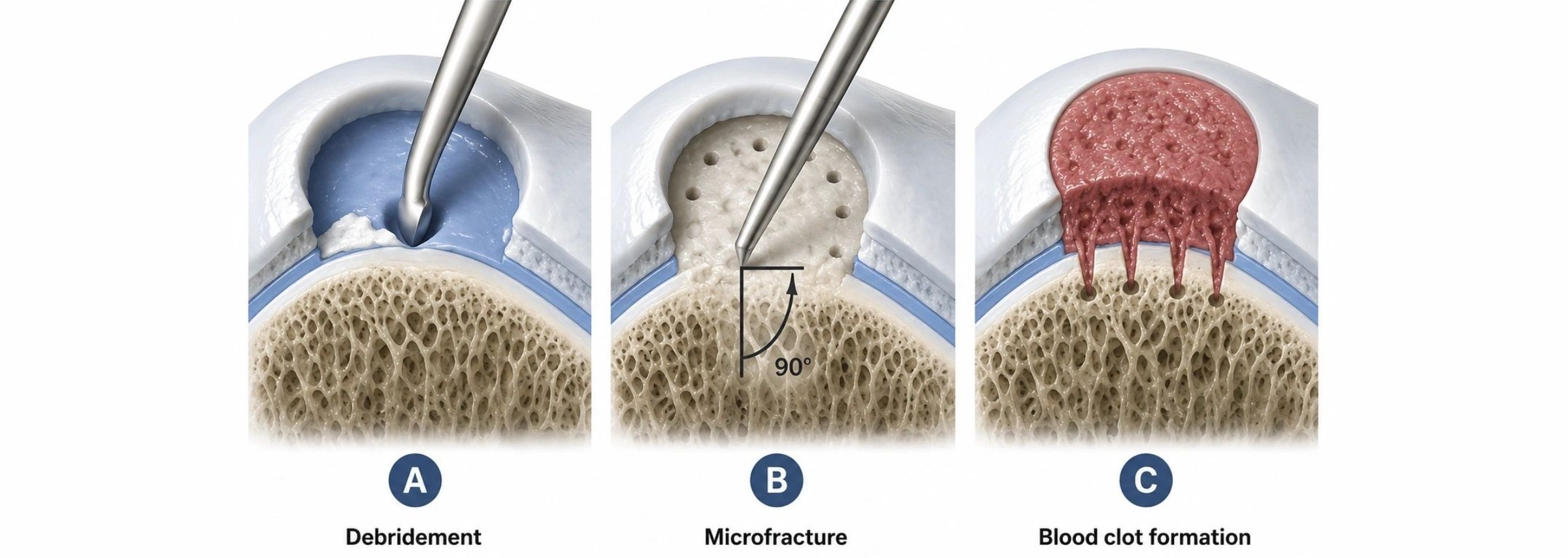 Microfracture: three-step illustration showing the damaged cartilage cleared to stable edges, small holes made in the bone beneath, and a blood clot filling the defect