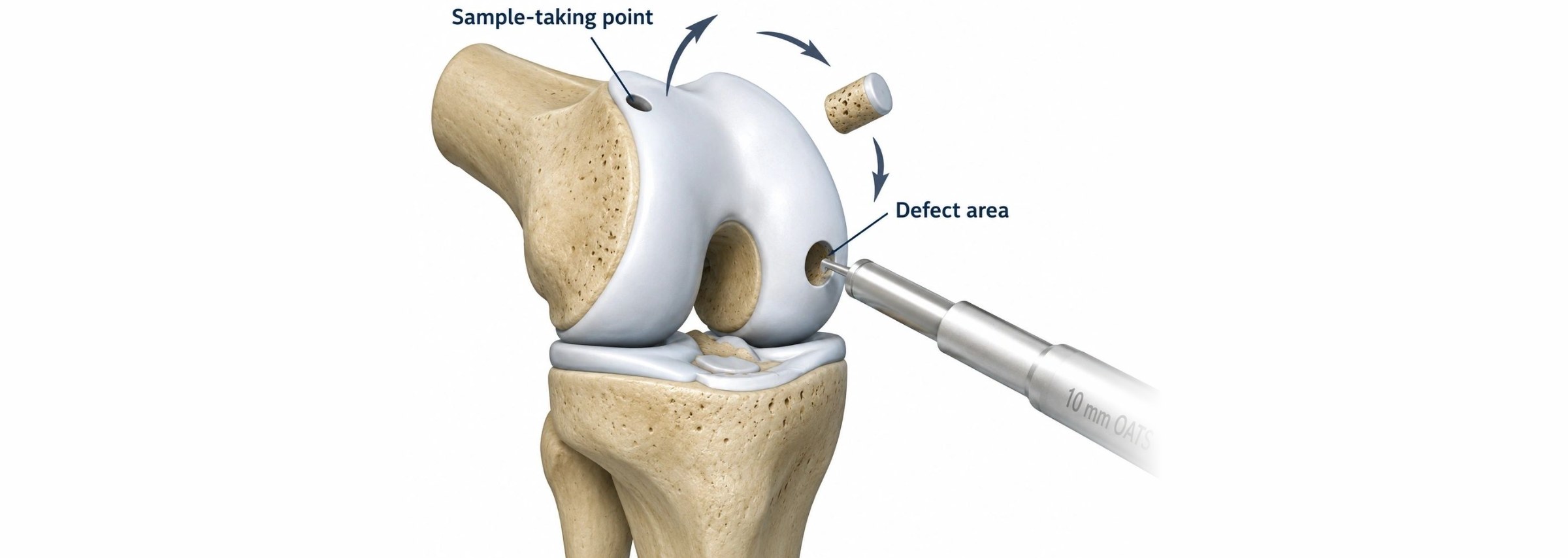 Osteochondral autograft transfer: illustration of the knee showing a plug of bone and cartilage taken from a less weight-bearing area and moved into a cartilage defect
